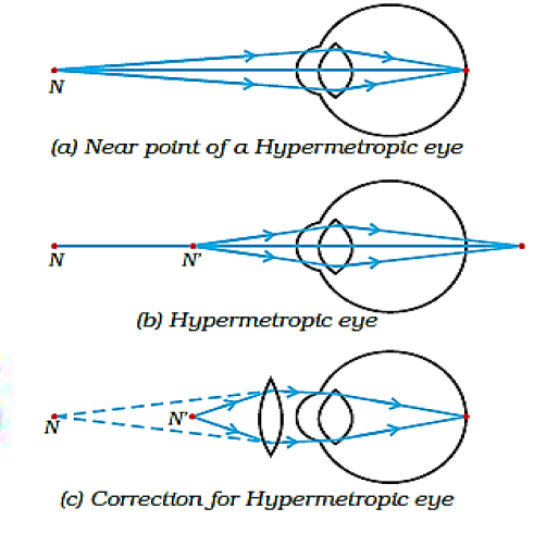 Human eye and colourful world class 10 notes 5 Hypermetropia correction using convex lens diagram