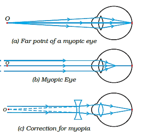 Human eye and colourful world class 10 notes 4 Myopia correction using concave lens diagram